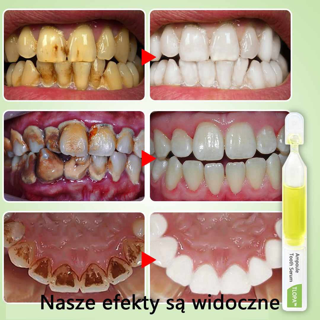 🌈TLOPA™ Pasta do Zębów w Ampułkach, Usuwanie kamienia nazębnego i bakterii płytki nazębnej oraz różnych problemów jamy ustnej