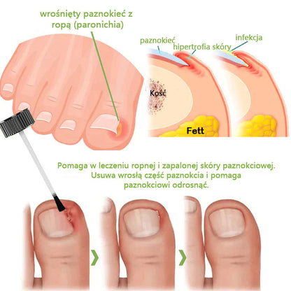 FOOTCURE™ Żel do usuwania wrastającego paznokcia (infekcje grzybicze, wrastający paznokieć, odbarwione lub uszkodzone paznokcie)🔥(Ograniczona zniżka - ostatnie 30 minut)